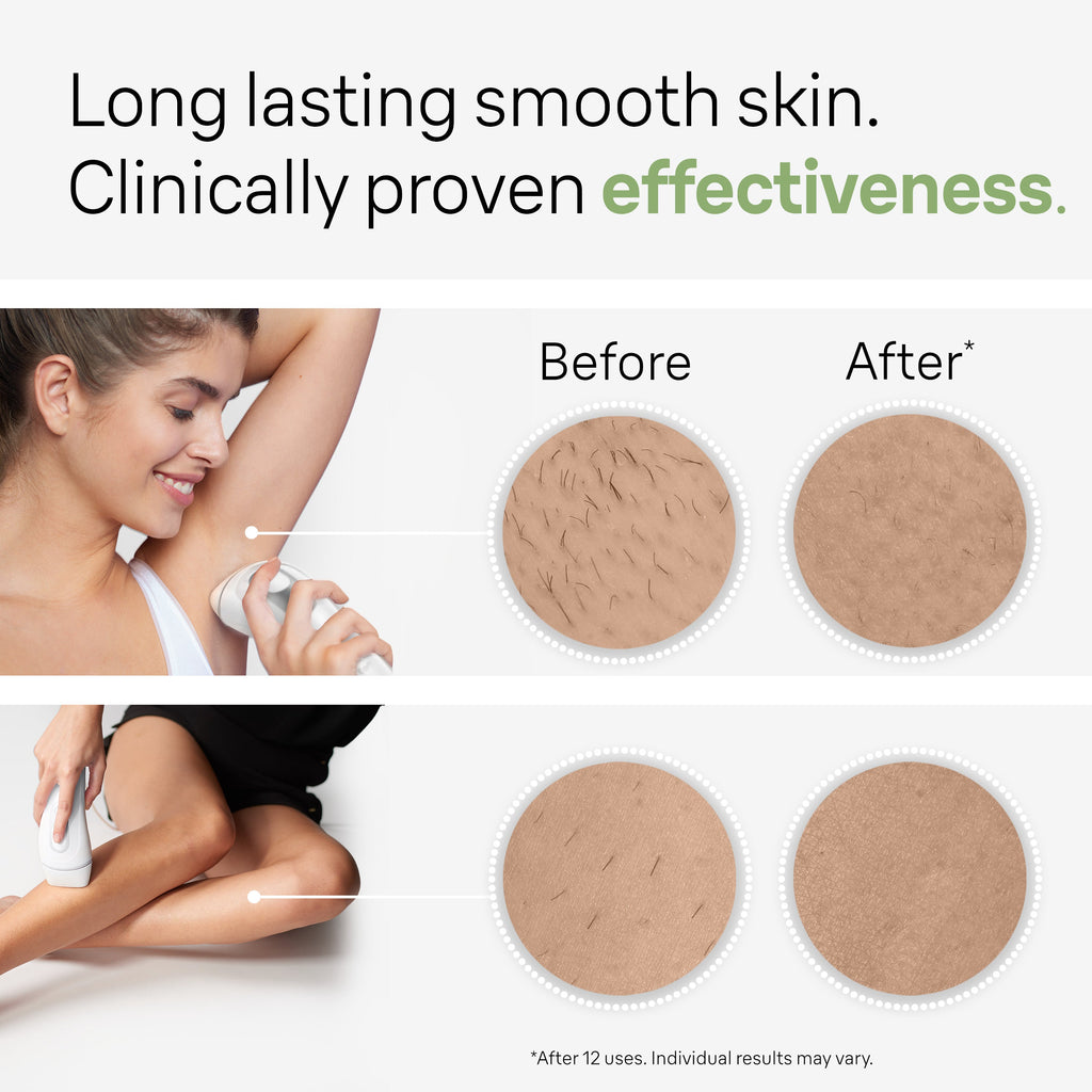 Braun Smart IPL Silk·expert Pro 3: At Home Alternative to Laser Hair Removal for Women and Men At-Home Hair Removal System IPL3020